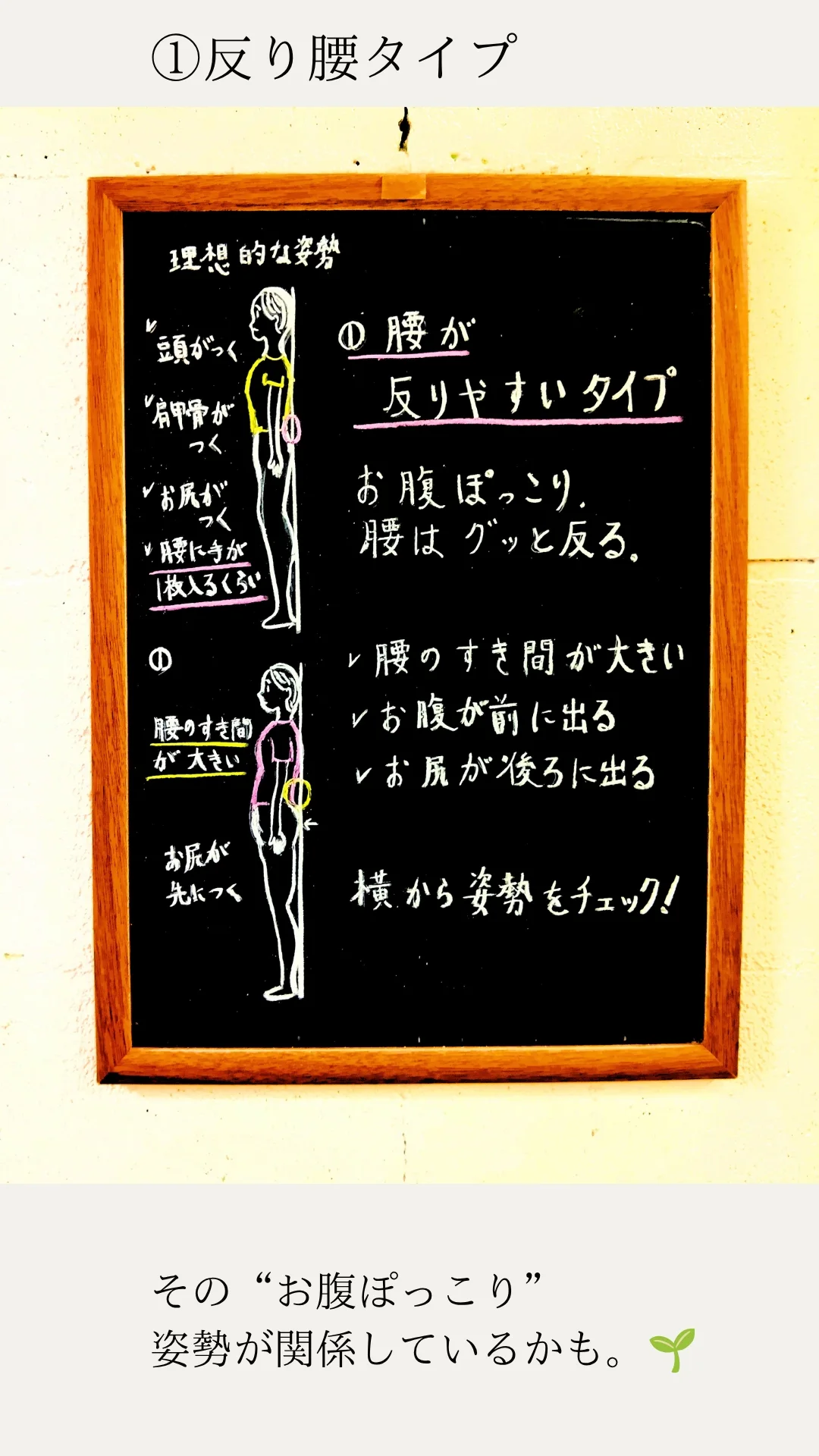 反り腰タイプを説明したナカタニ整骨院の手描き黒板イラスト
